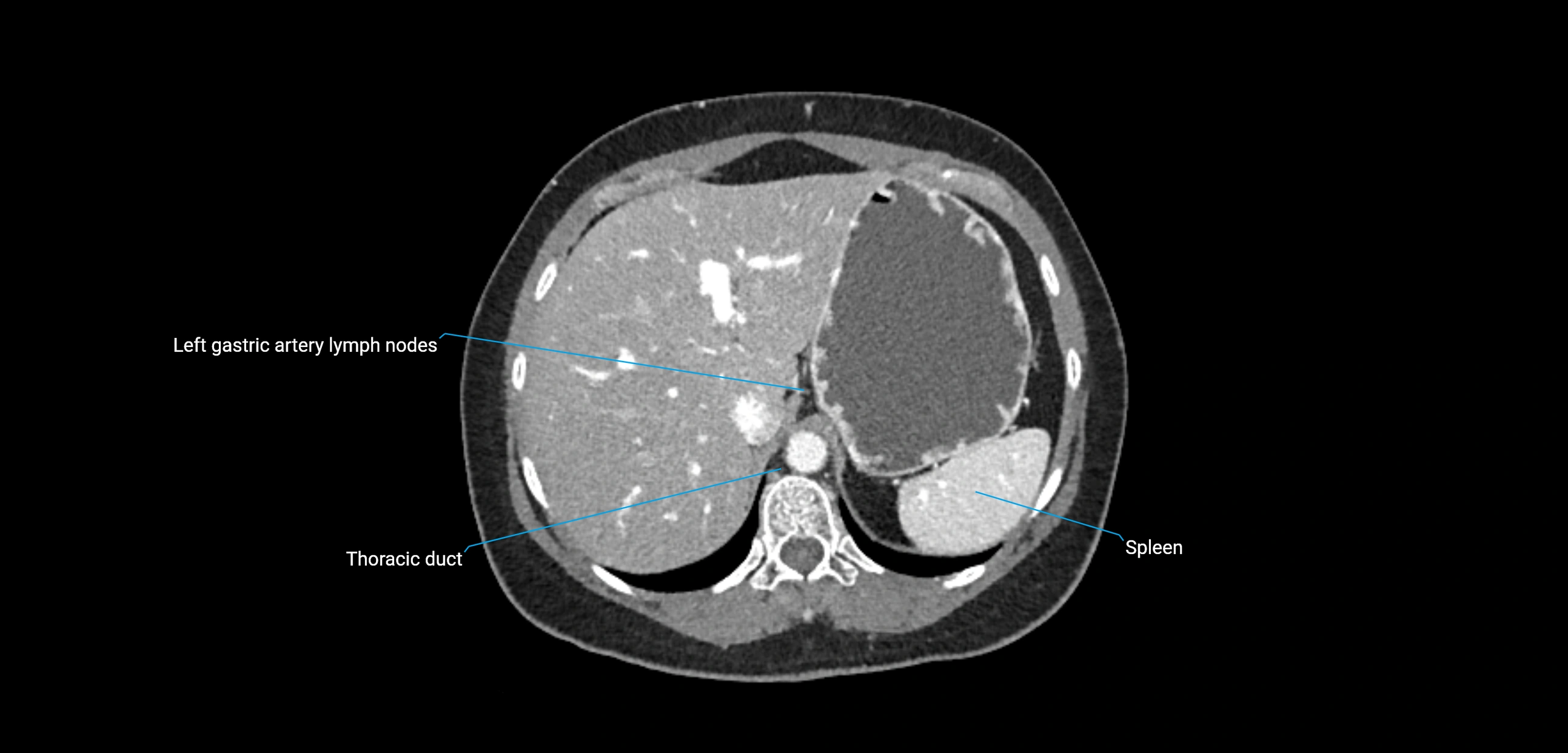 CT ct abdominal lymph nodes  axial cross sectional anatomy  enchanced radiology image -img-00002-00111.webp